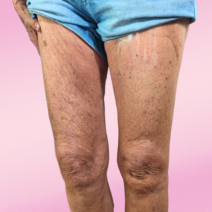 SmoothSkin Cellulite Strips