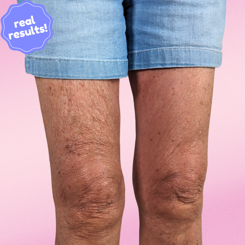 SmoothSkin Cellulite Strips