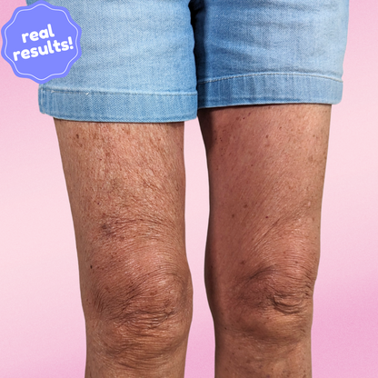 SmoothSkin Cellulite Strips