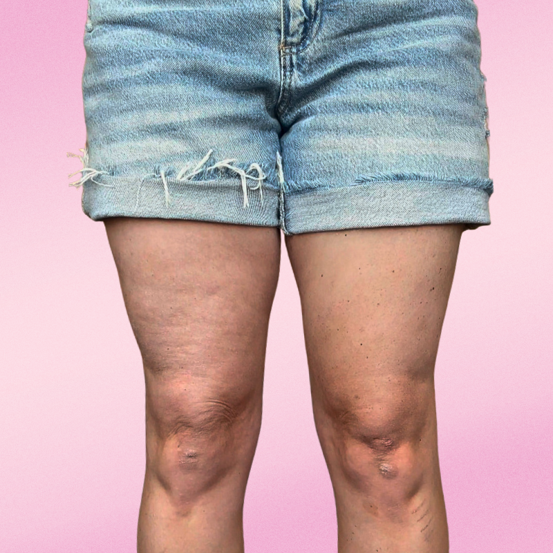 SmoothSkin Cellulite Strips